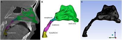 Rapid Maxillary Expansion Has a Beneficial Effect on the Ventilation in Children With Nasal Septal Deviation: A Computational Fluid Dynamics Study